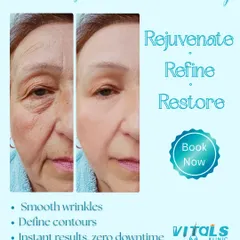 This before-and-after result demonstrates how we can rejuvenate, refine, and restore a youthful appearance. By smoothing wrinkles and defining contours, we enhance your natural beauty with instant, zero-downtime results.