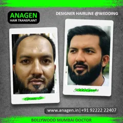 For this patient with Grade 5 hair loss, we designed a new, robust hairline and beard to frame his face. The 5000 graft procedure created a powerful, masculine look, perfect for his upcoming wedding.