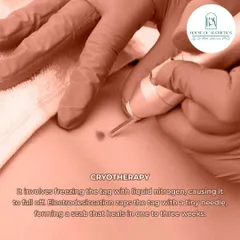 We use Cryotherapy, which involves freezing the tag with liquid nitrogen, causing it to fall off naturally. Another option is Electrodesiccation, which zaps the tag with a tiny needle, forming a scab that heals within a few weeks.