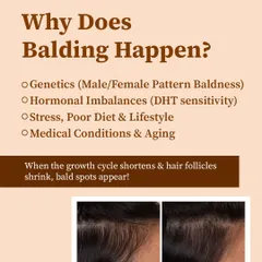 Why does balding happen? It's often a mix of genetics, hormonal imbalances like DHT sensitivity, and lifestyle factors. When the hair growth cycle shortens and follicles shrink, bald spots appear.