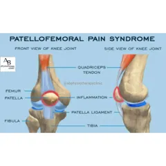 Patellofemoral Pain Syndrome, or "runner's knee," causes pain in the front of the knee. It's often due to muscle imbalances or overuse, which we address with targeted therapy.