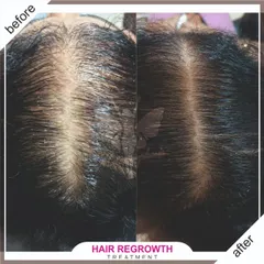 This before and after shows the successful treatment of female pattern hair thinning. We were able to restore significant volume and reduce the appearance of the scalp partition.
