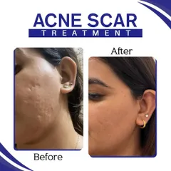 This before and after image is a powerful example of our acne scar treatment. We focus on significantly improving skin texture and reducing the depth of scars to restore smooth skin and confidence.