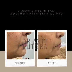 Dermal fillers are highly effective for softening laugh lines (nasolabial folds) and lifting a "sad mouth" (marionette lines). This treatment provides a subtle lift that makes a significant difference.