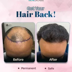 Getting your hair back should be a safe and effective process. This transformation highlights how we address significant balding to deliver permanent, natural results that you can count on.