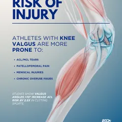 Athletes with uncontrolled knee valgus are at a significantly higher risk for ACL tears, patellofemoral pain, and other chronic overuse issues.