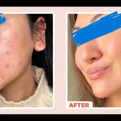 This patient's journey with MNRF shows a remarkable improvement in skin clarity and tone. This treatment is a gold standard for tackling both acne scars and general skin dullness.