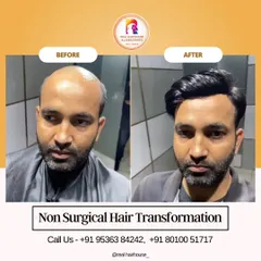 This before and after comparison highlights how I can effectively cover advanced stages of baldness. The hair patch integrates perfectly, creating a dense and healthy appearance.