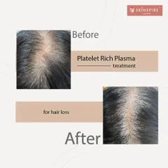 Here you can see the before and after results of a Platelet Rich Plasma (PRP) treatment. This non-surgical procedure is highly effective for tackling early-stage hair loss and thinning. Notice the significant improvement in hair density and scalp coverage, achieved by stimulating the hair follicles with the body's own healing properties.