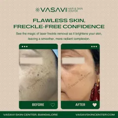 This before and after comparison demonstrates the successful removal of freckles using a targeted laser treatment. The procedure effectively lightened the dense clusters of freckles on the patient's face, resulting in a clearer and more uniform complexion.