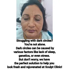 Dark circles can be caused by genetics, stress, or lack of sleep, but you are not alone. This image shows a client before her treatment, highlighting a common concern we effectively address at our clinic to help you look fresh and rejuvenated.