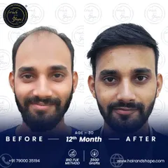 A complete transformation after 12 months using the BIO FUE method. With 3500 grafts, we achieved a full, youthful look that speaks for itself.