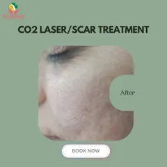 This "after" photo displays the remarkable improvement in skin texture following a CO2 laser treatment series. The scars are visibly reduced, and the skin is smoother and more even.