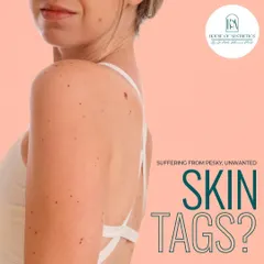 Suffering from pesky, unwanted skin tags? While harmless, they can be annoying. We offer quick and effective solutions to remove them, helping you achieve the smooth skin you desire.