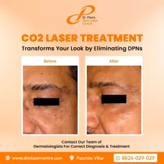 Here you can see the results of a CO2 laser treatment for eliminating DPNs, which are small, dark spots on the skin. The treatment effectively clears these spots for a more even complexion.