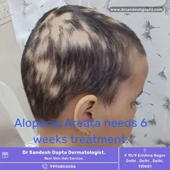 This image shows a child with Alopecia Areata, an autoimmune condition causing patchy hair loss. It is important to know that this condition is treatable, often requiring a course of about six weeks to see regrowth.