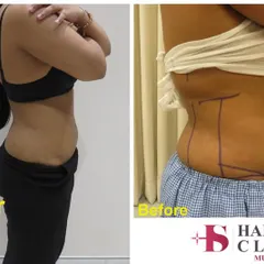 A side profile view of a liposuction procedure. The 'before' image shows the surgical markings I use to plan the fat removal from the abdomen and flanks. The 'after' image reveals a smoother, flatter contour and a significant reduction in the bulge that concerned the patient.