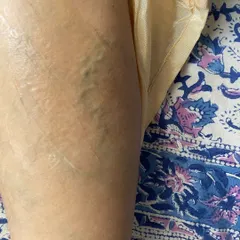 This photo was taken part-way through the treatment process. You can already see a visible reduction in the prominence and discoloration of the veins as our therapy begins to take effect.