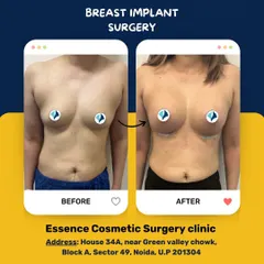 This before-and-after image displays the outcome of a breast implant surgery. The patient wanted to restore volume and achieve a fuller shape. We selected implants that complement her body frame to create a natural-looking enhancement.