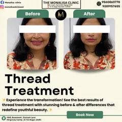 See the transformative power of a non-surgical thread treatment. This client's 'before' and 'after' photos highlight a noticeable lift in the lower face and jawline, resulting in a more defined and youthful facial contour with minimal downtime.