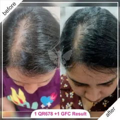 This client's fantastic result was achieved with a combination therapy of just one QR678 session and one GFC session. This shows how I tailor treatments to get effective results efficiently.