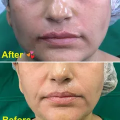 This before and after demonstrates the immediate effect of hyaluronic acid fillers for lip plumping. My technique focuses on enhancing the natural shape and volume of the lips, correcting asymmetries and providing a fuller, yet balanced, look.
