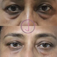 Tired of looking tired? Under-eye puffiness is a common concern, but it doesn't have to be permanent. This before-and-after shows the significant reduction in eye bags after just one session of PDO threads, helping my patient look rested and rejuvenated.