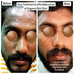 Here is another successful acne treatment result from my clinic. We focus on affordable and effective solutions to help you regain confidence in your skin.