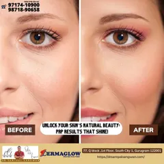 This before-and-after image shows the real results of my Platelet-Rich Plasma (PRP) treatment. Notice the significant reduction in fine lines and improved skin texture around the eye, resulting in a brighter, more youthful appearance. This is what I mean by restoring your skin's natural beauty.