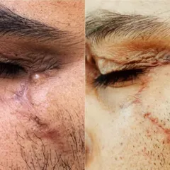 This image shows the outcome of a surgical scar revision procedure for a prominent scar located near the eye. Our goal with scar revision is to make the scar less conspicuous by altering its size, texture, and direction, leading to a significant cosmetic improvement.