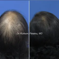 This top-down view clearly shows the increase in hair volume and scalp coverage. Hair loss in women is common, and I want to assure you that effective, evidence-based solutions are available.