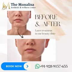 Witness the clarifying effect of our advanced laser treatments. This before and after comparison shows a remarkable reduction in acne and post-inflammatory marks, resulting in smoother, healthier-looking skin.