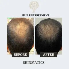 A clear before-and-after comparison of a patient who underwent PRP therapy. The 'after' photo shows a noticeable increase in hair density and coverage at the crown after a course of treatments.