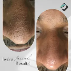 A clear demonstration of the HydraFacial's power to decongest skin. The "before" image shows clogged pores and blackheads on the nose, while the "after" reveals a smooth, clear surface post-treatment.