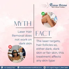 A common myth is that laser hair removal doesn't work on dark skin. This is a fact check. Our modern lasers target the hair follicle, making the treatment effective on any skin type, whether fair or dark.