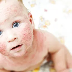 This infant is experiencing atopic dermatitis, or eczema, a common condition in babies. My approach is to soothe the inflammation with gentle, safe treatments and educate parents on how to manage the condition at home to prevent flare-ups.