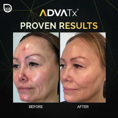 A clear example of AdvaTx results for active acne and redness. The 'after' photo shows a calmer, clearer complexion with improved skin tone and texture.