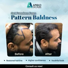 We provide effective solutions for male pattern baldness. This client's hairline was redesigned and restored, resulting in a more youthful look and a significant boost in confidence.