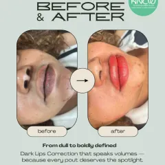 This before-and-after demonstrates our Dark Lips Correction treatment. We can move from dull to boldly defined, correcting hyperpigmentation for a naturally vibrant pout.