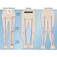 This diagram shows the difference between normal alignment, bowlegs, and knock knees. These structural variations can contribute to knee and hip pain, and we can provide exercises to help manage them.