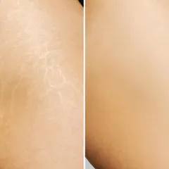 Stretch marks are a form of scarring that occurs when the skin stretches rapidly. This before-and-after shows the improvement possible with treatments like fractional laser or microneedling, which help to rebuild collagen and improve skin texture.