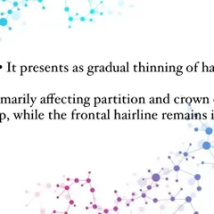 The classic presentation of FPHL is a gradual thinning of hair, most noticeably at the crown and along the hair partition. Unlike male pattern baldness, the frontal hairline typically remains intact.