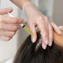 Here is a close-up of a PRP injection being administered to the scalp. The procedure is precise and targets areas of thinning to revitalize hair follicles. It is a safe and minimally invasive way to encourage natural hair regrowth.
