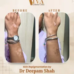 This image shows the progress of vitiligo treatment on a patient's wrist and forearm. The 'after' photo shows the white patches filling in with pigment. Early and consistent treatment is key to managing vitiligo and achieving the best possible results.