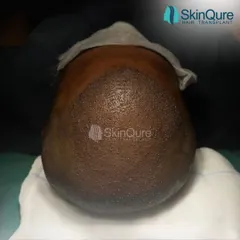 Hair transplant is an art form. This image shows the scalp immediately after the placement of thousands of grafts. Each one is meticulously placed to ensure the correct density and direction, laying the groundwork for a completely natural result.