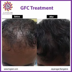A close-up view of the results from our Growth Factor Concentrate (GFC) treatment. The hair appears visibly thicker and the scalp coverage has improved, demonstrating effective hair regrowth.