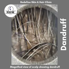 This is a magnified view of a scalp with dandruff. Understanding the problem at a microscopic level helps us provide effective, targeted treatments to eliminate flakes, reduce itching, and restore scalp health.
