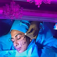 This image from a live demonstration shows the strategic placement of Aptos threads for a non-surgical facelift. These threads are used to lift sagging tissues and stimulate collagen for a rejuvenated and defined facial structure.