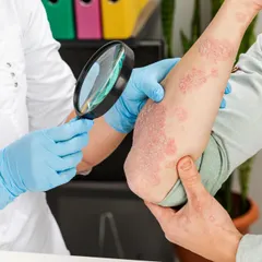 A correct diagnosis is the first step to effective treatment. Here, I am examining a case of psoriasis, a chronic condition that requires a careful, long-term management plan. My approach goes beyond just treating the visible patches; it's about understanding your triggers and creating a sustainable plan to manage flare-ups and improve your quality of life.