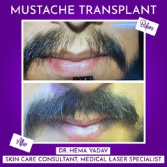 For many men, a full mustache is an important feature. This before-and-after comparison demonstrates how a mustache transplant can fill in gaps and create a much thicker, more prominent look. The results are completely natural and grow just like your own hair.